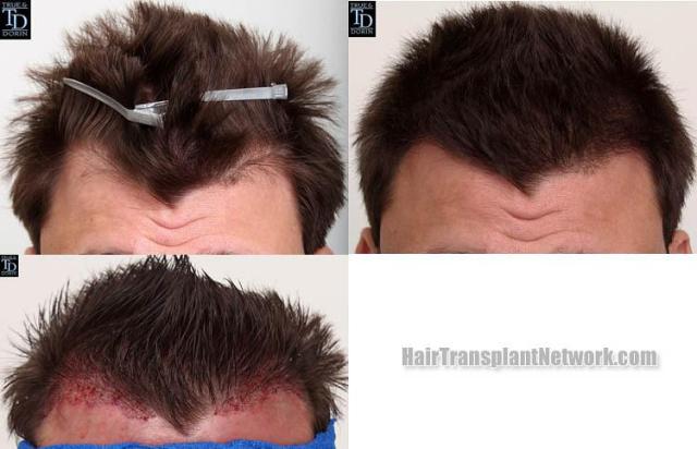 Hair restoration procedure before and after results