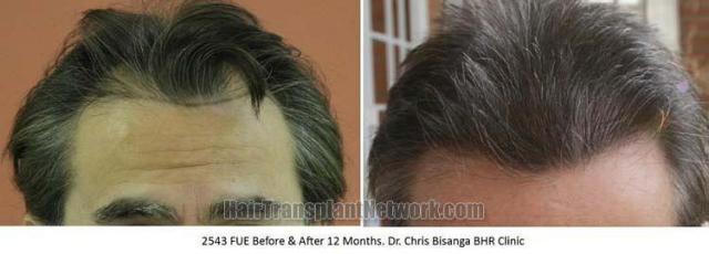 Hair transplantation surgery before and after photos