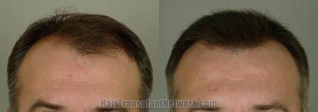 Hair transplantation surgery before and after photos