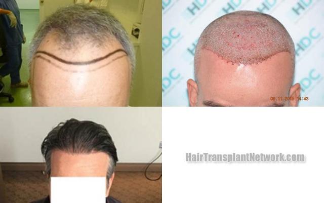 Hair transplantation surgery before and after photos