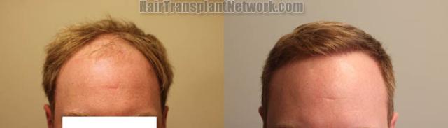 Front view - Before and after hair restoration procedure