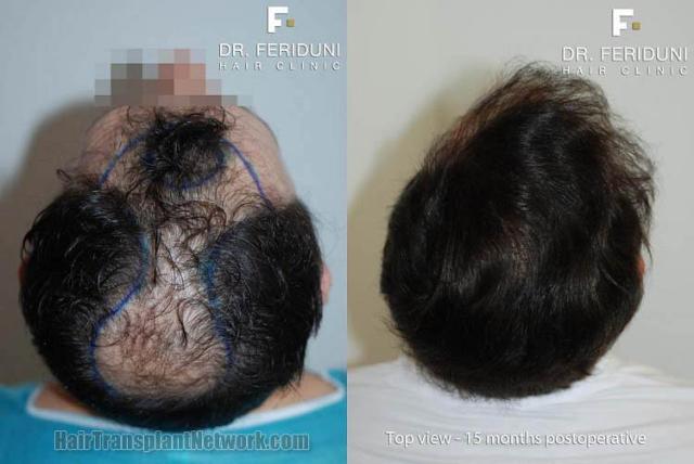 Surgical hair transplantation result photographs