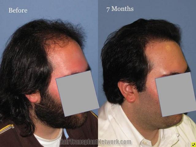 Hair transplantation surgery before and after photos