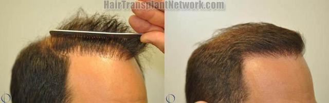 Hair transplantation surgery before and after images