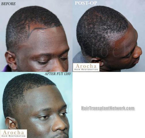 Hair transplantation surgery before and after photos