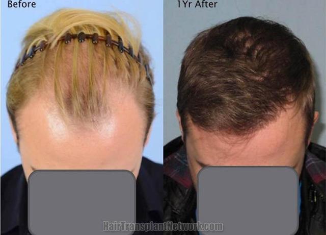 Hair restoration procedure before and after results