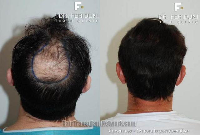 Hair restoration procedure before and after pictures