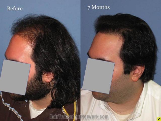 Hair transplantation surgery before and after photos