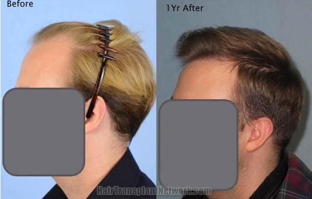 Hair transplantation surgery before and after pictures