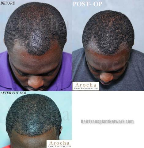 Hair restoration procedure before and after results