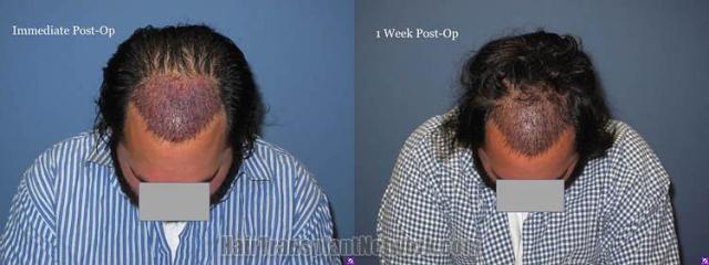 Hair restoration surgery before and after images