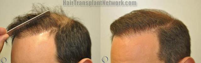 Hair transplantation surgery before and after pictures