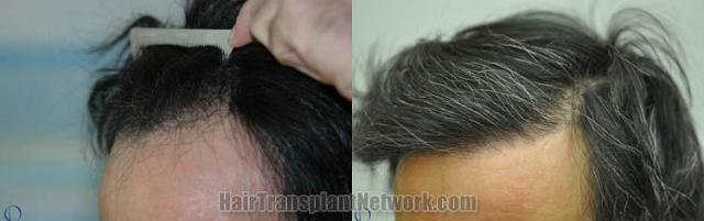 Hair restoration procedure before and after pictures