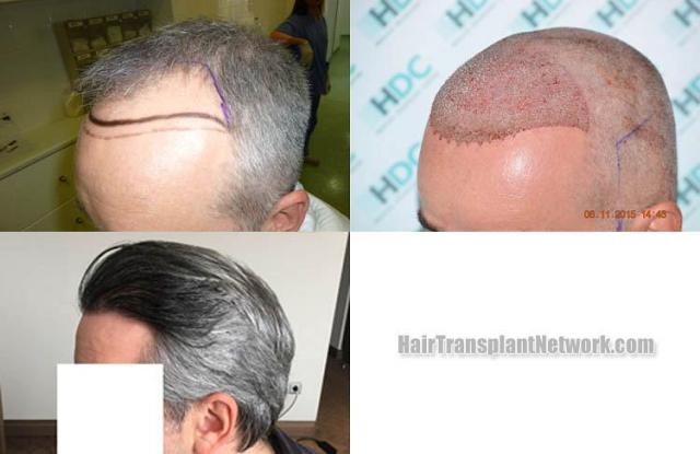 Hair transplantation surgery before and after pictures