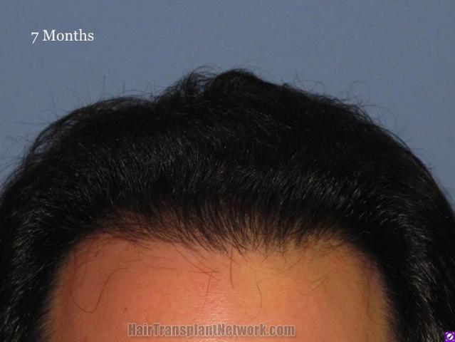 Hair restoration procedure before and after pictures