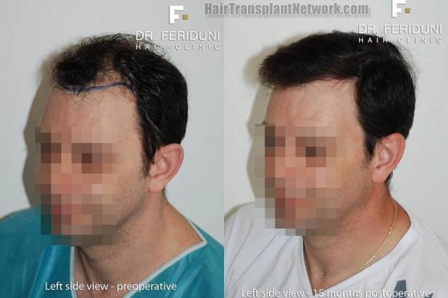 Hair transplantation surgery before and after pictures