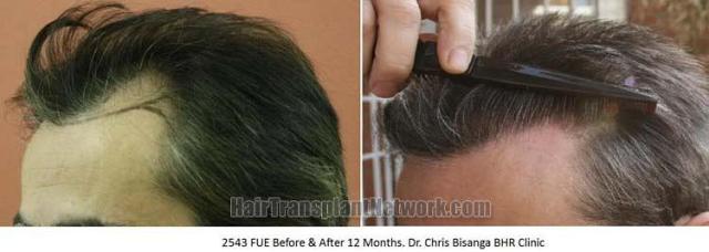 Hair restoration procedure before and after pictures