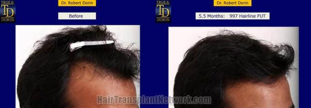 Hair transplantation surgery before and after images