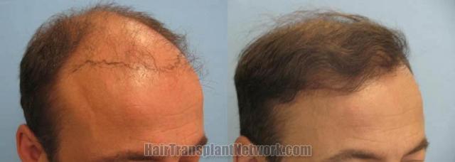 Hair transplantation surgery before and after images