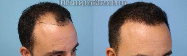 Hair transplantation surgery before and after images