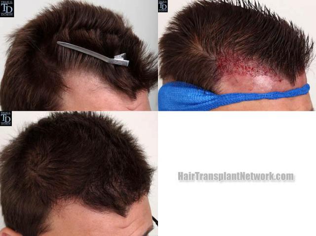 Hair transplantation surgery before and after images