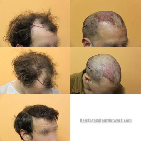 Hair transplantation surgery before and after images