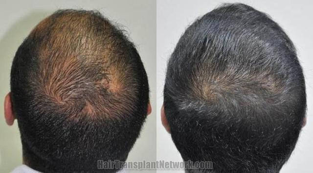 Hair restoration procedure before and after pictures