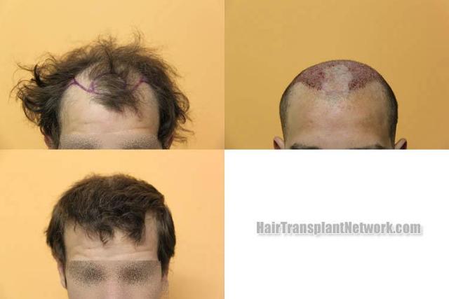 Hair restoration procedure before and after results