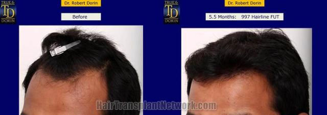 Hair transplantation surgery before and after pictures