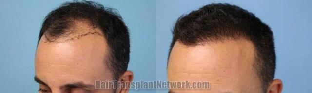 Hair transplantation surgery before and after images