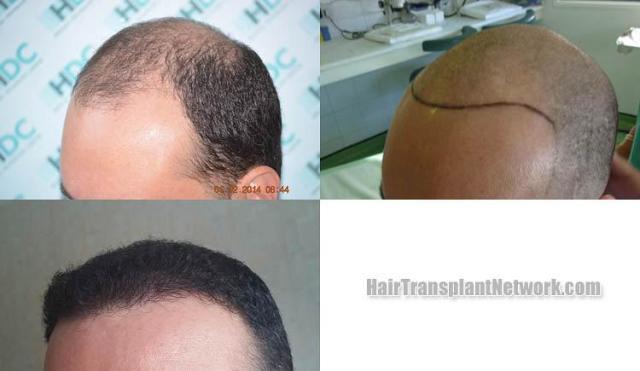 Hair transplantation surgery before and after images