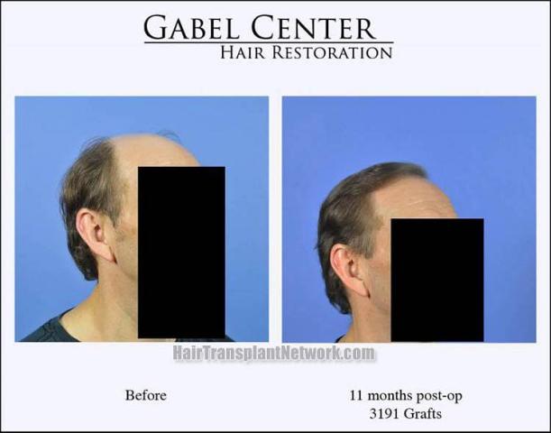 Hair transplantation surgery before and after images