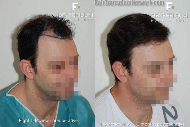 Hair transplantation surgery before and after images