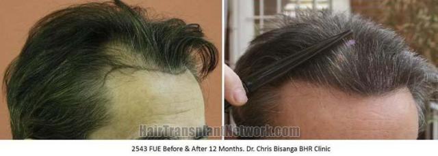 Hair transplantation surgery before and after pictures