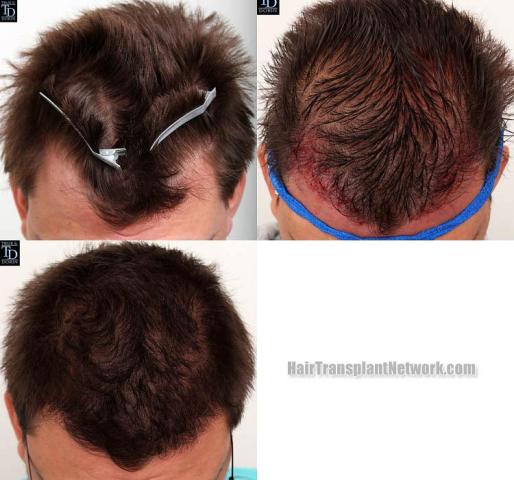 Hair transplantation surgery before and after photos