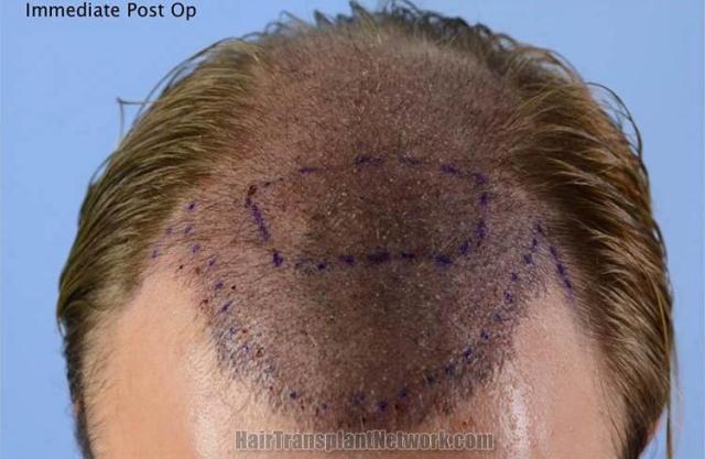 Hair restoration procedure before and after pictures