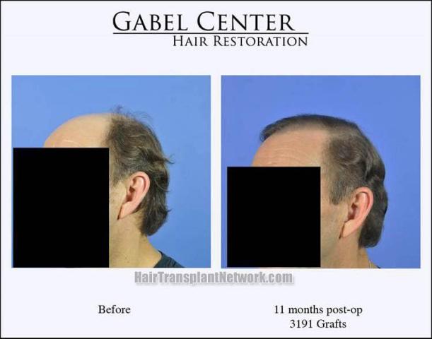 Hair transplantation surgery before and after pictures