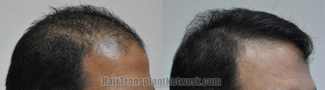 Hair transplantation surgery before and after images