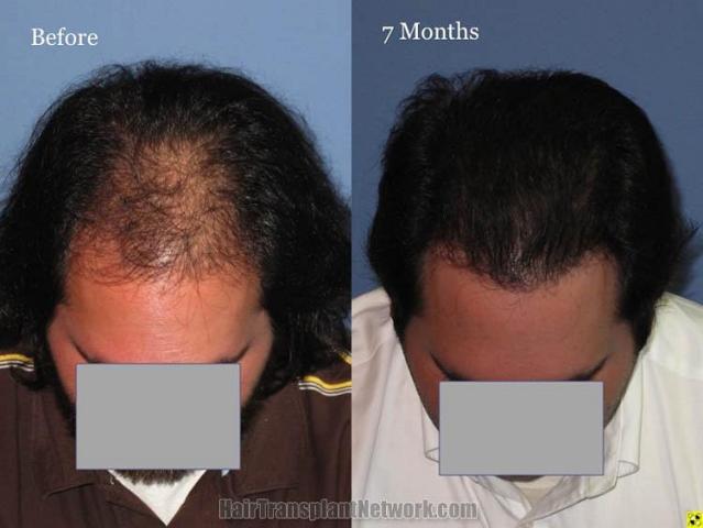 Hair restoration surgery before and after photos