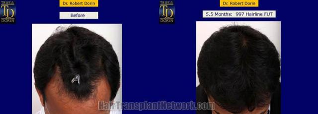 Hair transplantation surgery before and after photos