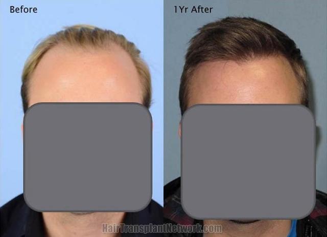 Hair restoration procedure before and after results