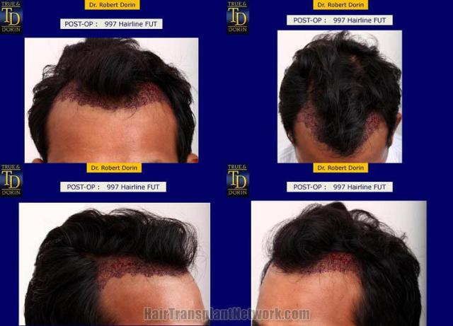 Hair restoration procedure before and after pictures