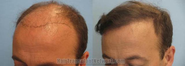 Hair transplantation surgery before and after pictures