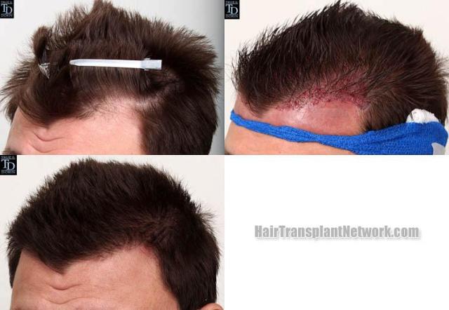 Hair transplantation surgery before and after pictures