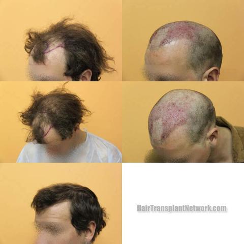 Hair transplantation surgery before and after pictures