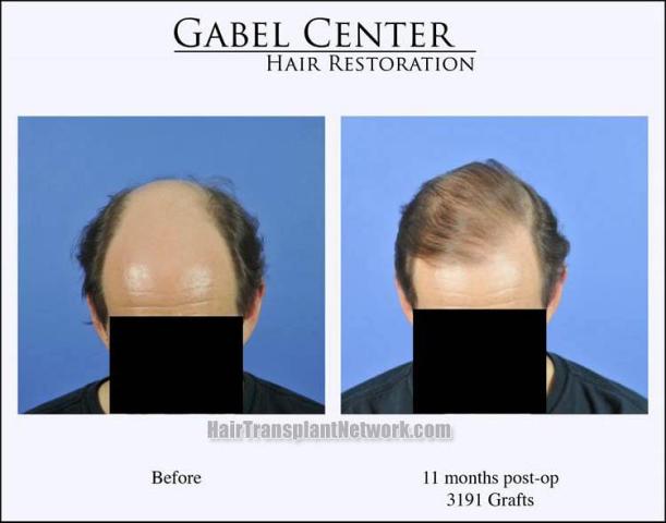 Hair restoration procedure before and after pictures