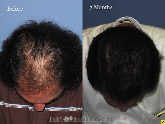 Hair restoration procedure before and after results