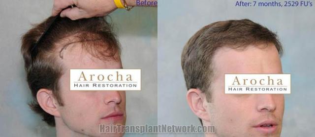 Before and after hair transplantation result photographs