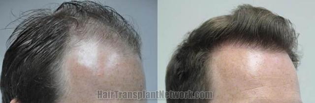 Hair transplantation surgery before and after photos