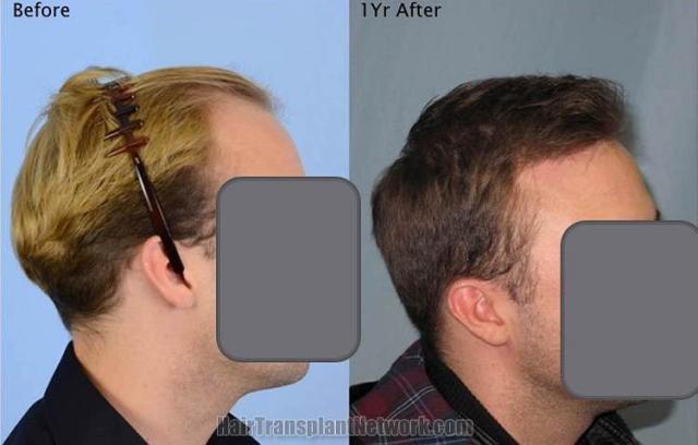 Hair transplantation surgery before and after images